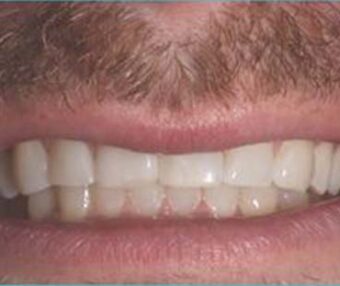 C1SPAfter After - Tooth Talk