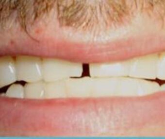 C1SPBefore Before - Tooth Talk