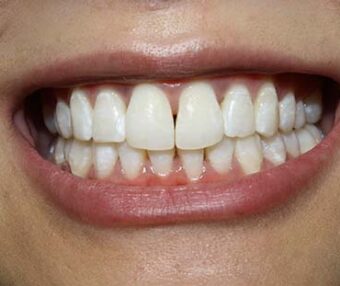 After - Tooth Talk