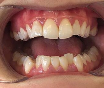 Before - Tooth Talk