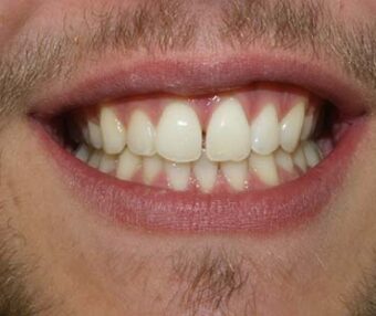 Before - Tooth Talk