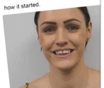 Before - Tooth Talk