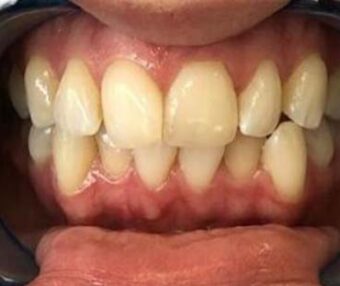 Before - Tooth Talk