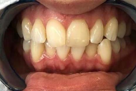 Before - toothtalk