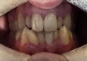 Before - toothtalk