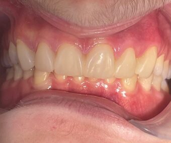 Olli-post-frontal After - Tooth Talk
