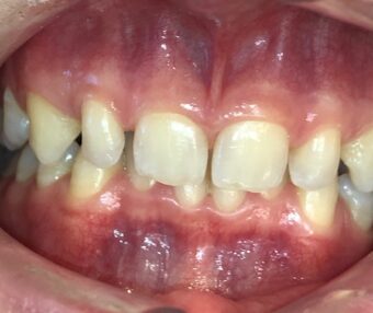 Olli-pre-fontal Before - Tooth Talk