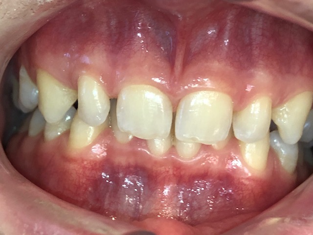 Before - toothtalk