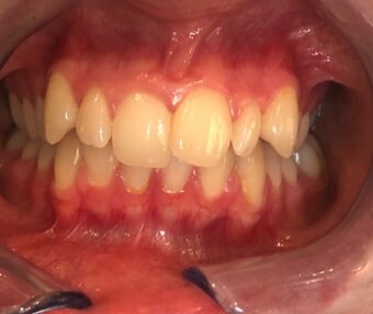 Furness_Shannon_Anterior Before - Tooth Talk