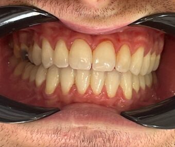 1 After - Tooth Talk