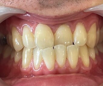 2 Before - Tooth Talk