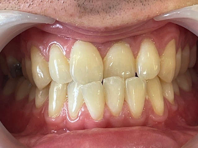 Before - toothtalk