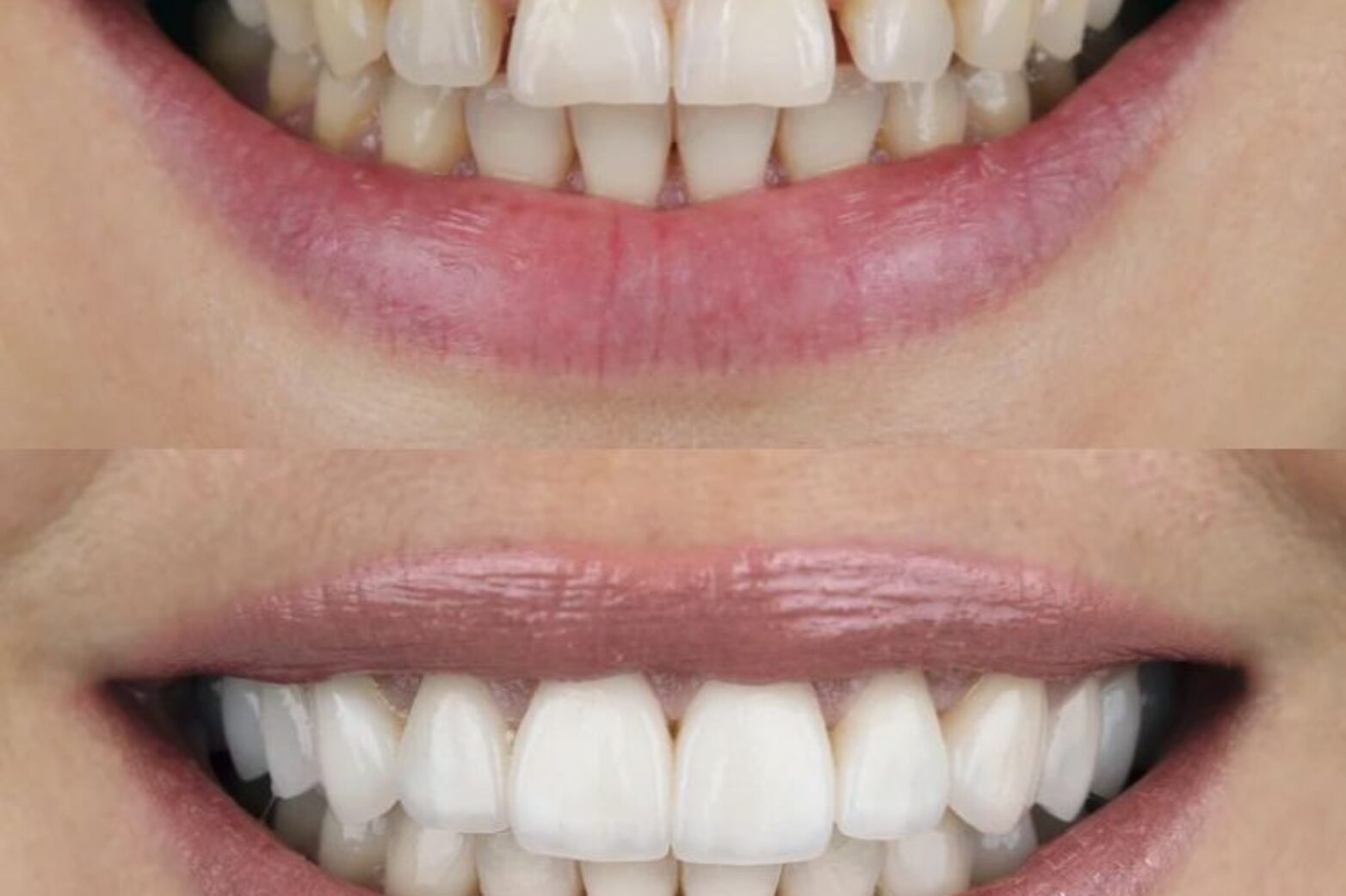 Affordable Composite Bonding Salisbury, Bolton, Liverpool, Penwortham