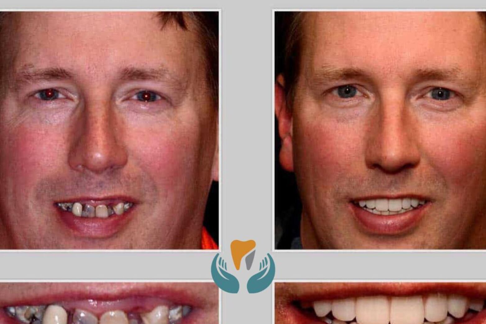 WhatsApp Image 2024-07-26 at 14.26.48 The 7 Different Types of Tooth Restoration