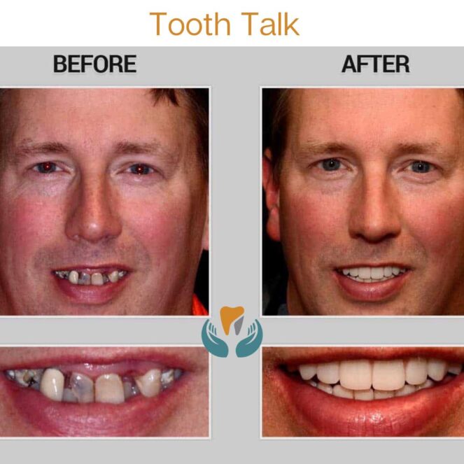 The 7 Different Types of Tooth Restoration