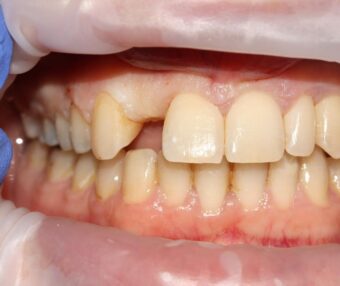 1 Before - Tooth Talk