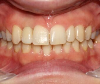 2 After - Tooth Talk