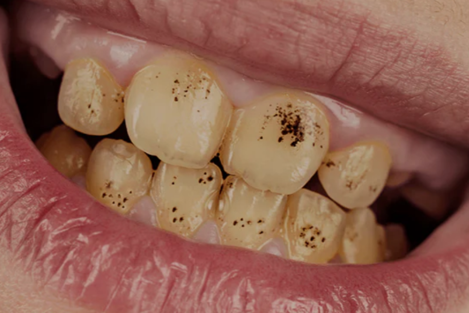 Black Spots on Teeth and Gums - Harmless Stains or a Serious Concern