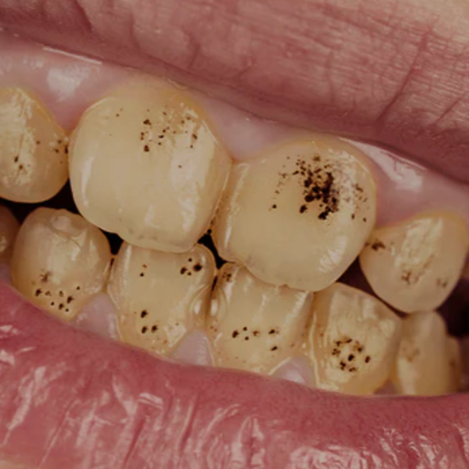 Black Spots on Teeth and Gums - Harmless Stains or a Serious Concern