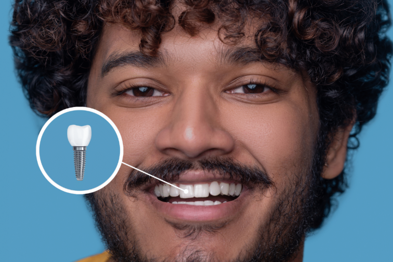 Same-Day Crowns - Are They Really as Durable as Traditional Ones