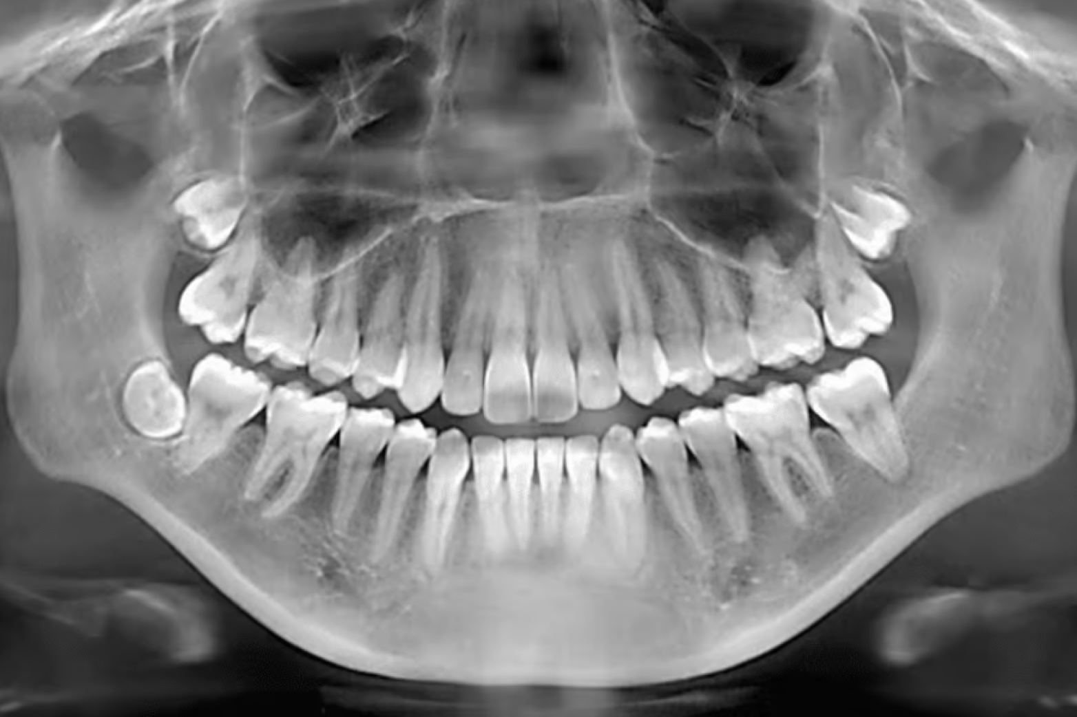 What Dental X-Rays Actually Reveal About Your Oral Health
