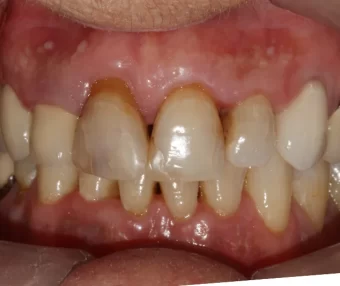 Before - Tooth Talk