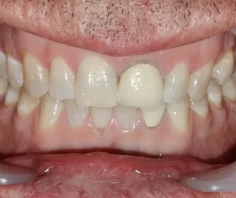 Before - Tooth Talk