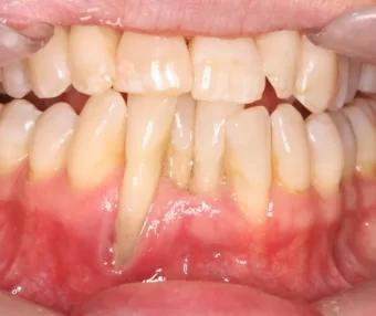 Before - Tooth Talk