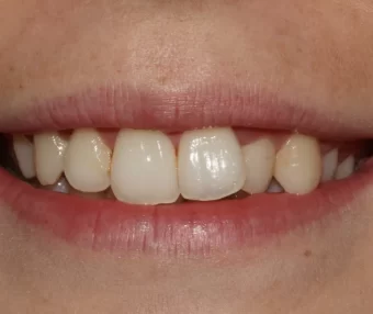 Before - Tooth Talk