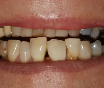 Before - Tooth Talk
