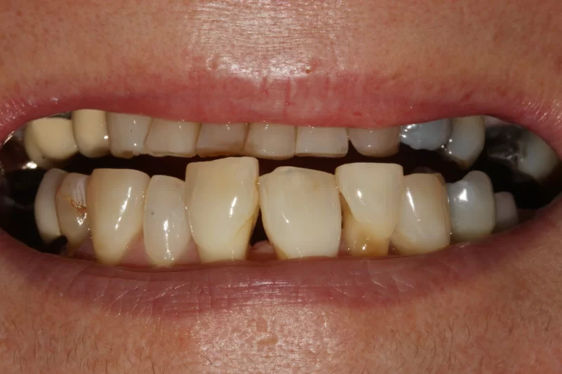 Before - toothtalk