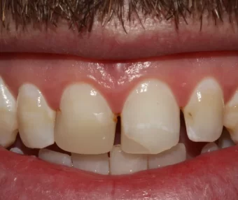 Before - Tooth Talk