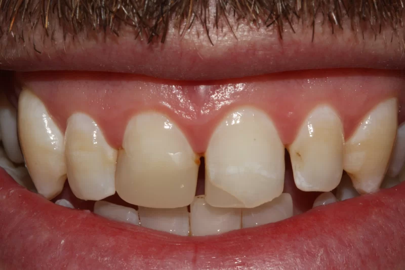 Before - toothtalk